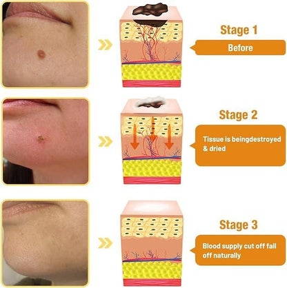 Bee Venom Wart & Mole Removal Cream (Pack of 2)